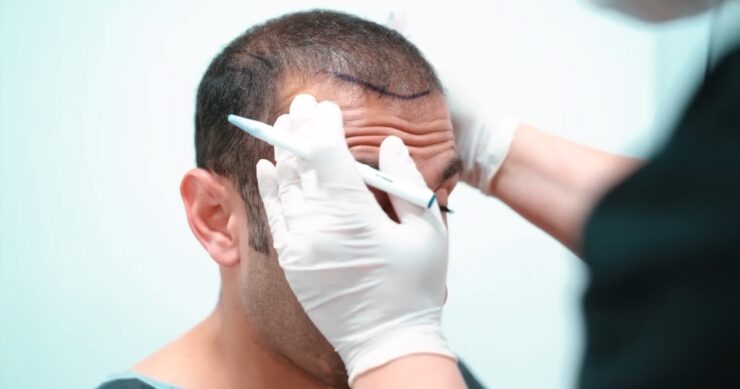 Doctor marking patient hairline for hair transplant operation